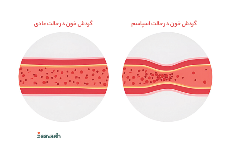 گردش خون در حالت عادی و اسپاسم